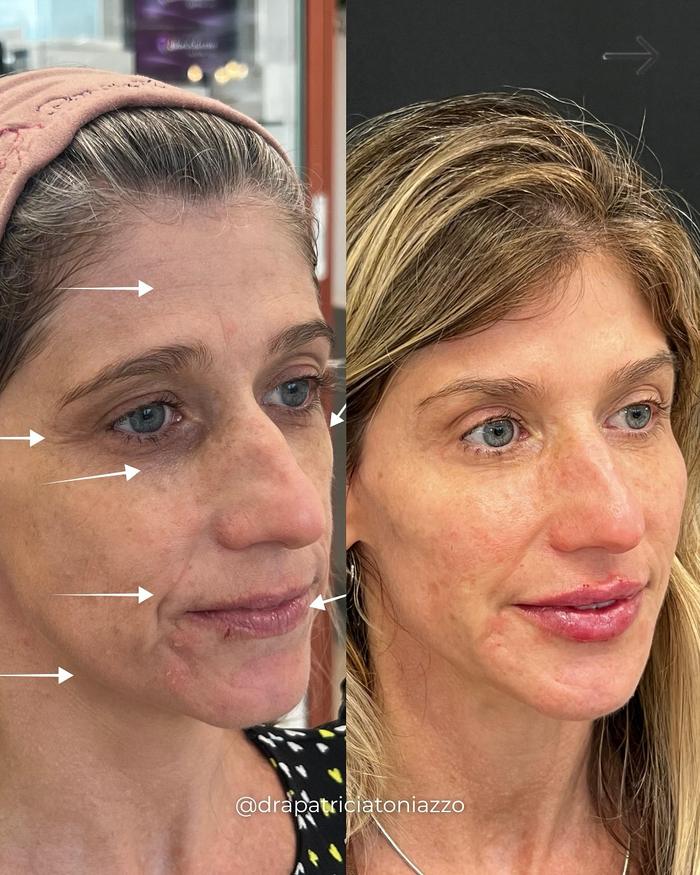 Antes e depois — harmonização