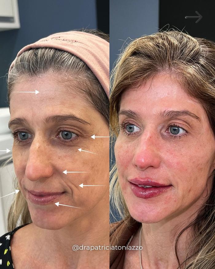 Antes e depois — harmonização