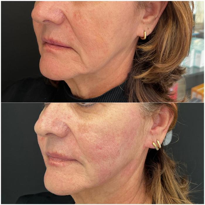 Antes e depois — rejuvenescimento