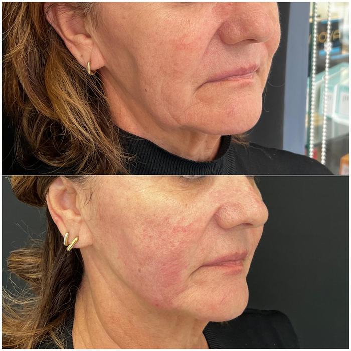 Antes e depois — rejuvenescimento