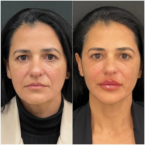 Harmonização full face — resultado