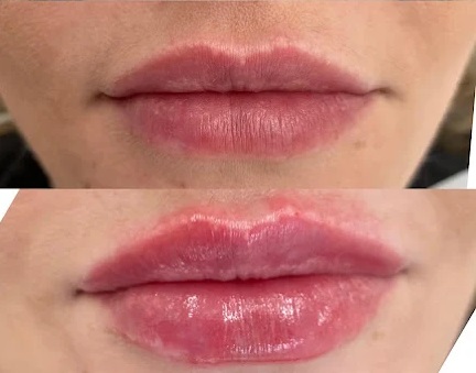 Preenchimento labial — resultado