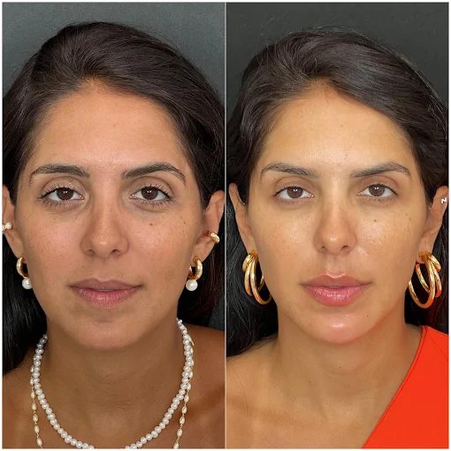 Toxina botulínica — resultado